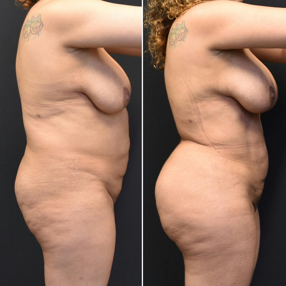 Liposuction Before & After Gallery - Patient 103465 - Image 2