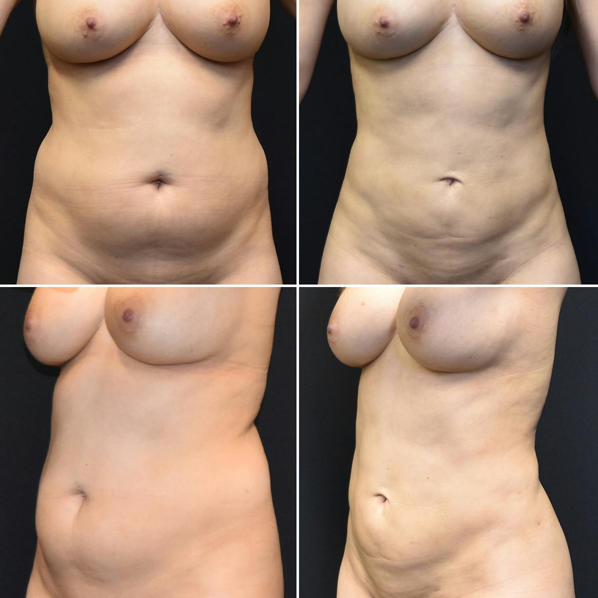 Liposuction Before & After Gallery - Patient 657438 - Image 1