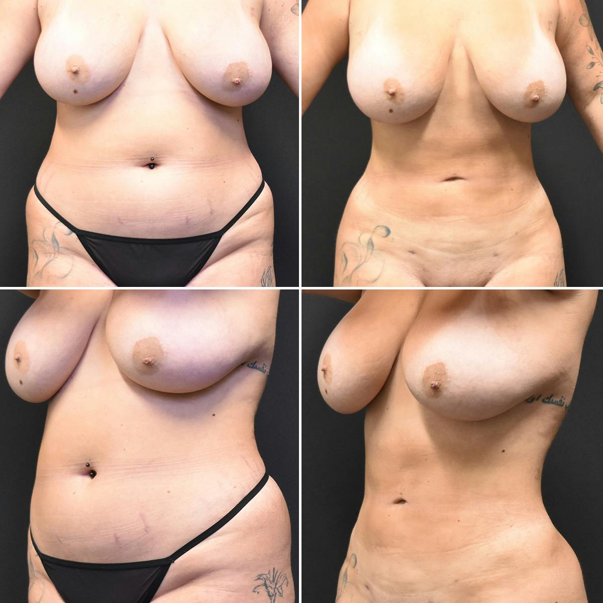 Liposuction Before & After Gallery - Patient 189616 - Image 1