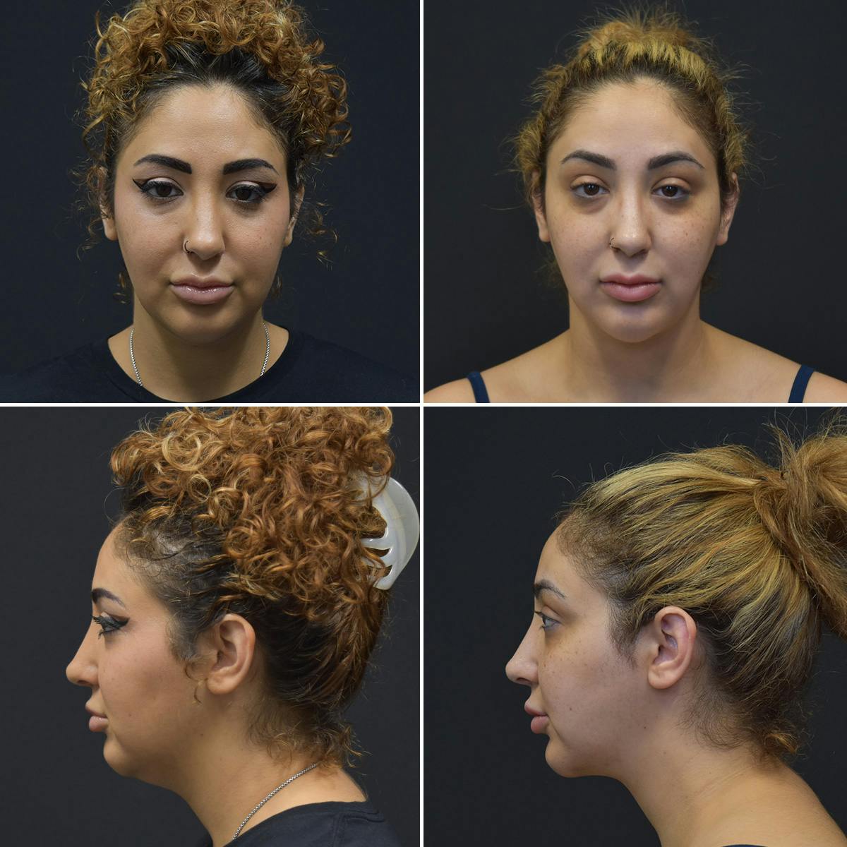 Liposuction Before & After Gallery - Patient 186002 - Image 1