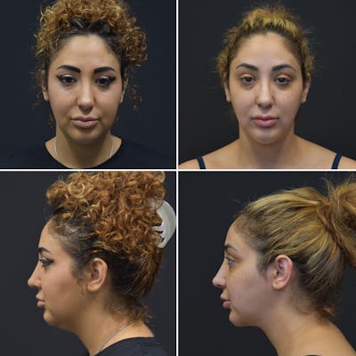 Liposuction Before & After Gallery - Patient 186002 - Image 1