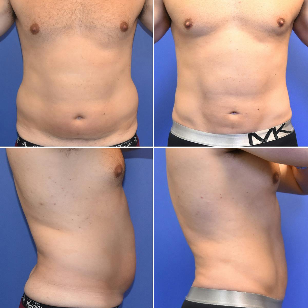 Male Liposuction Before & After Gallery - Patient 381923 - Image 1