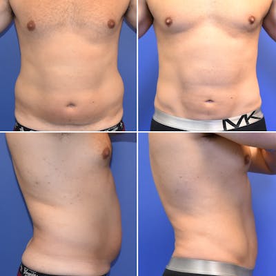 Male Liposuction Before & After Gallery - Patient 381923 - Image 1