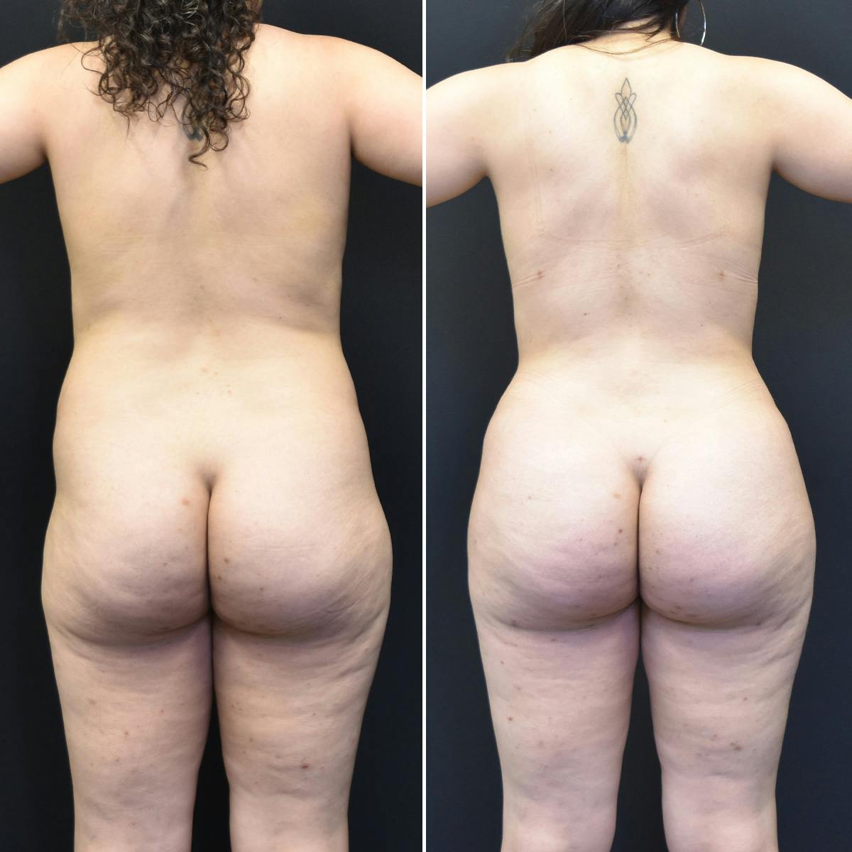 Brazilian Butt Lift Before & After Gallery - Patient 111230 - Image 1