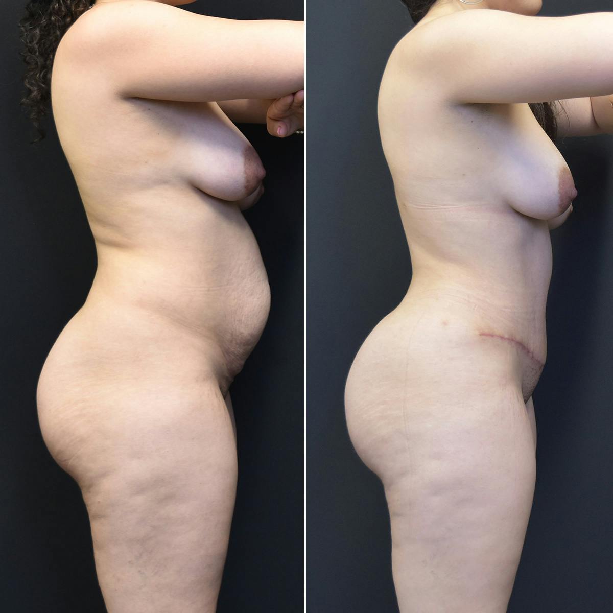 Brazilian Butt Lift Before & After Gallery - Patient 111230 - Image 2