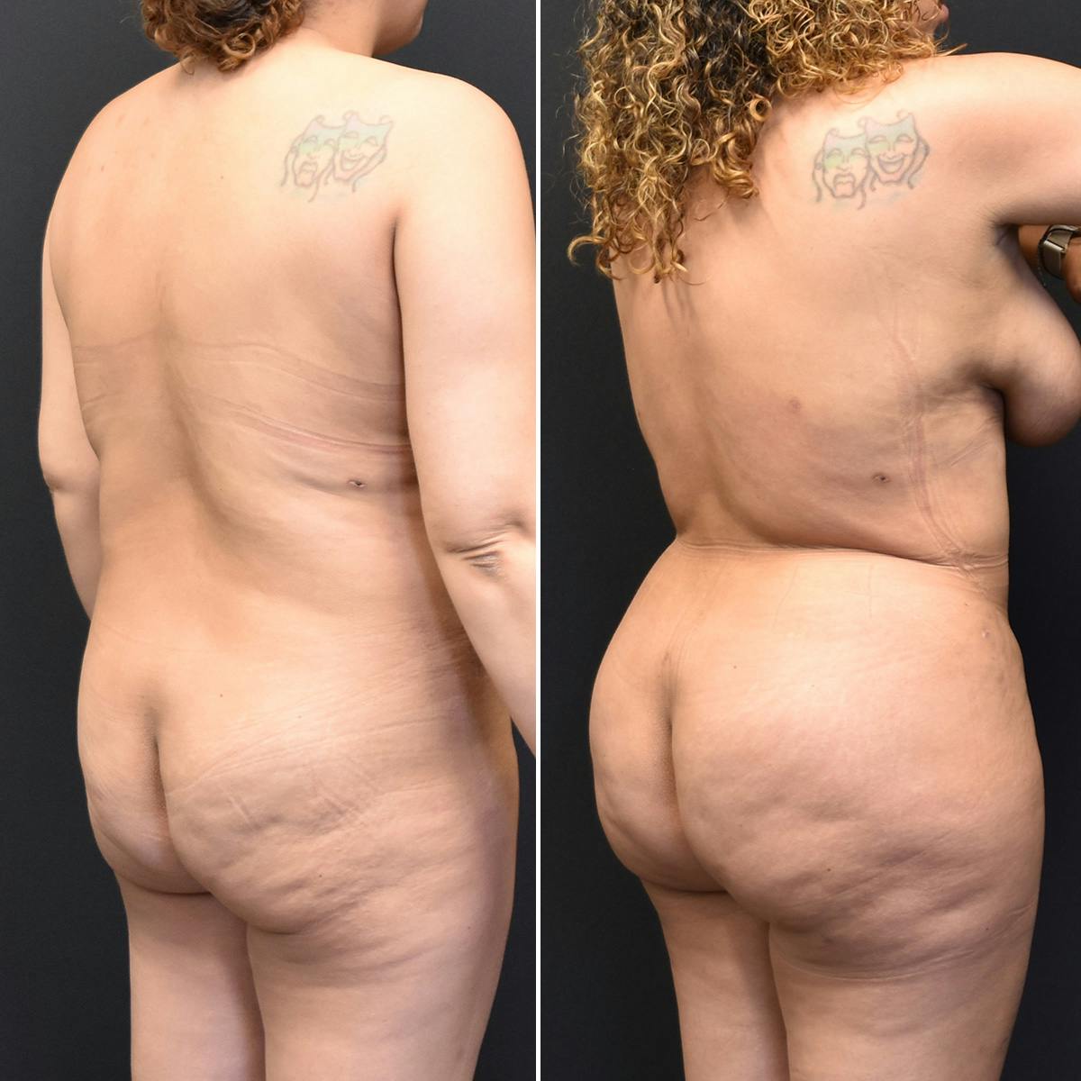 Brazilian Butt Lift Before & After Gallery - Patient 352417 - Image 2