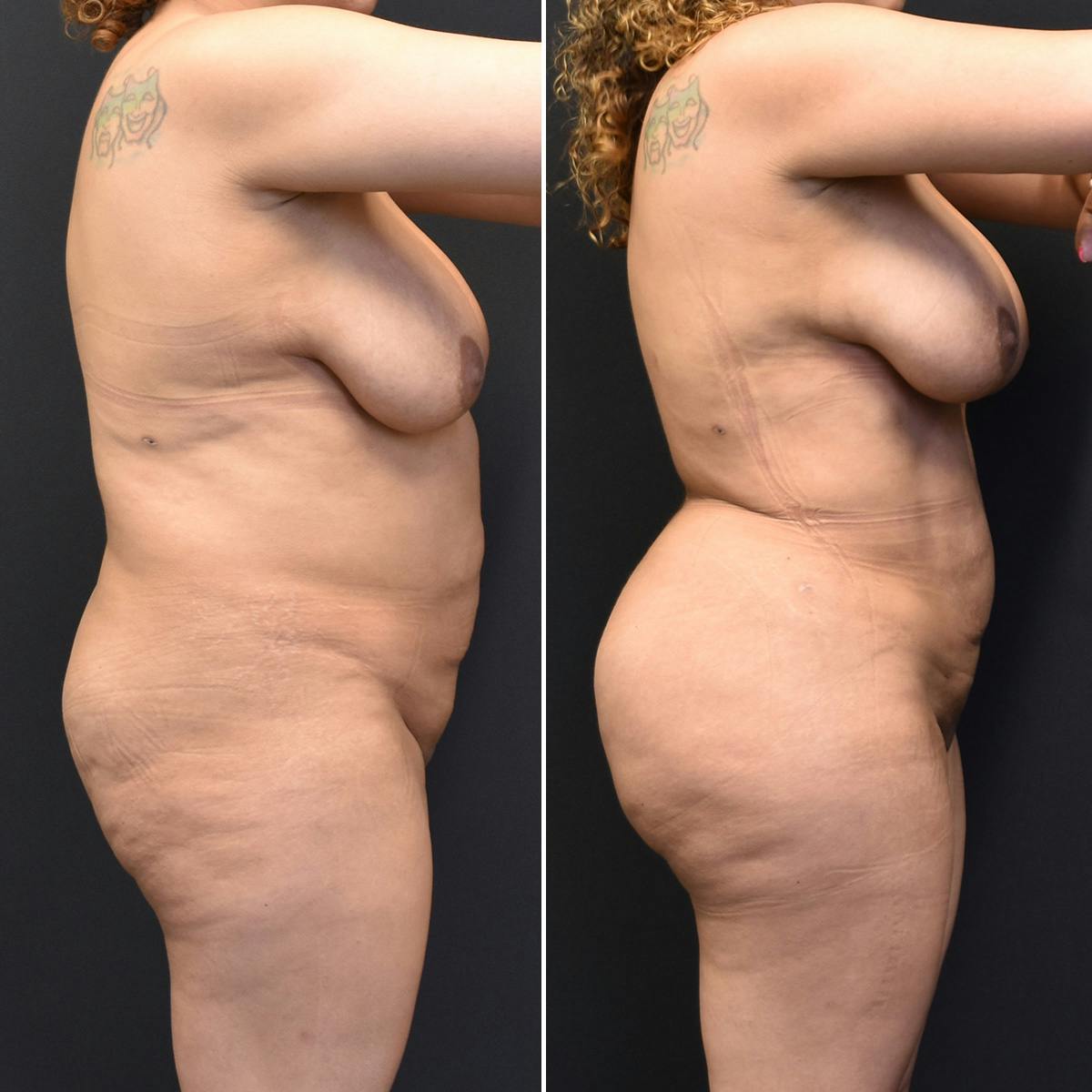 Brazilian Butt Lift Before & After Gallery - Patient 352417 - Image 3
