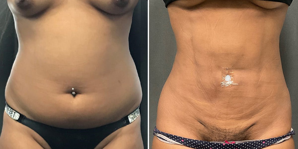 Renuvion Before & After Gallery - Patient 417693 - Image 1