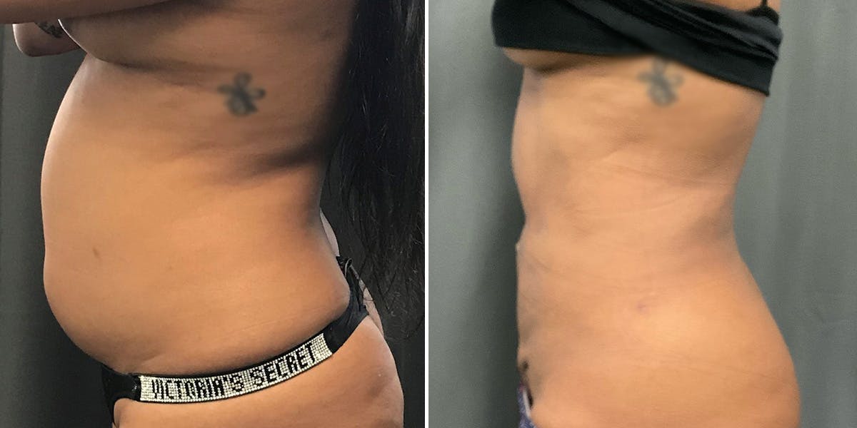 Renuvion Before & After Gallery - Patient 417693 - Image 2