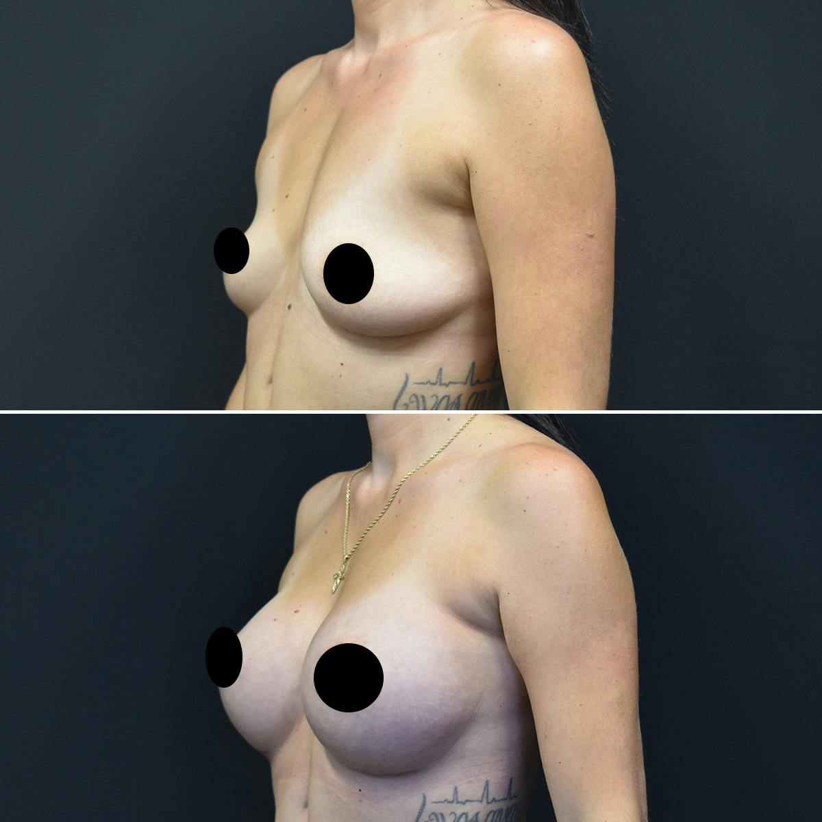 Breast Augmentation Before & After Gallery - Patient 378326 - Image 2