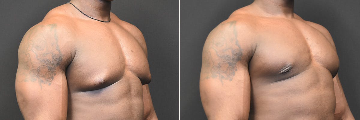 Gynecomastia Before & After Gallery - Patient 303340 - Image 2