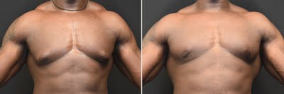 Gynecomastia Before & After Gallery - Patient 303340 - Image 1