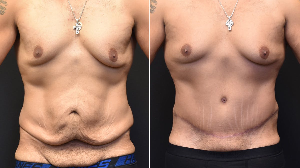 Male Tummy Tuck  Before & After Gallery - Patient 207595 - Image 1