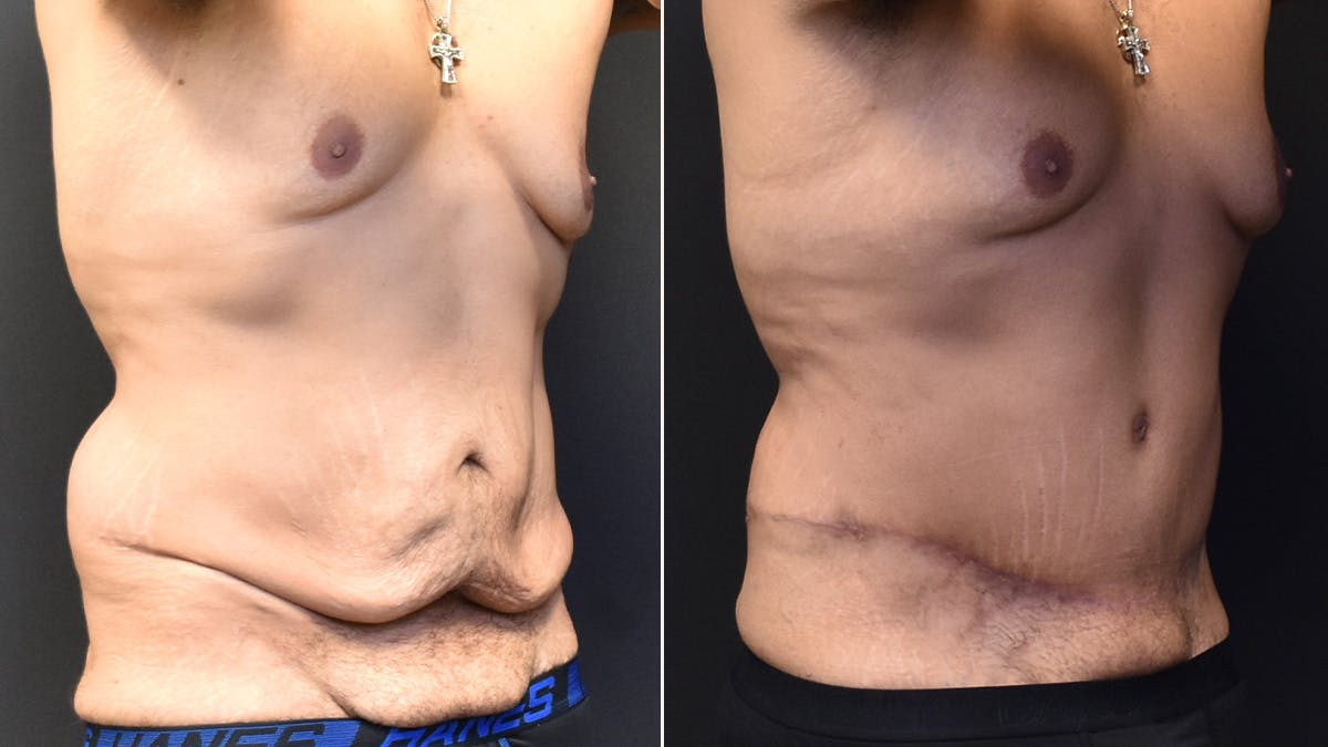 Male Tummy Tuck  Before & After Gallery - Patient 207595 - Image 2