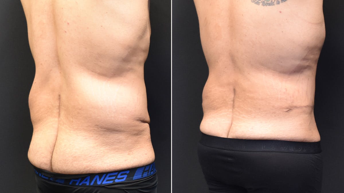 Male Tummy Tuck  Before & After Gallery - Patient 207595 - Image 3