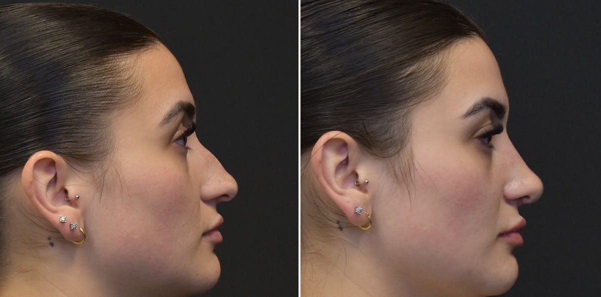 Rhinoplasty Before & After Gallery - Patient 330822 - Image 1