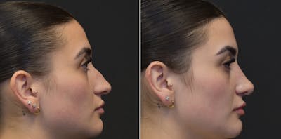 Rhinoplasty Before & After Gallery - Patient 330822 - Image 1