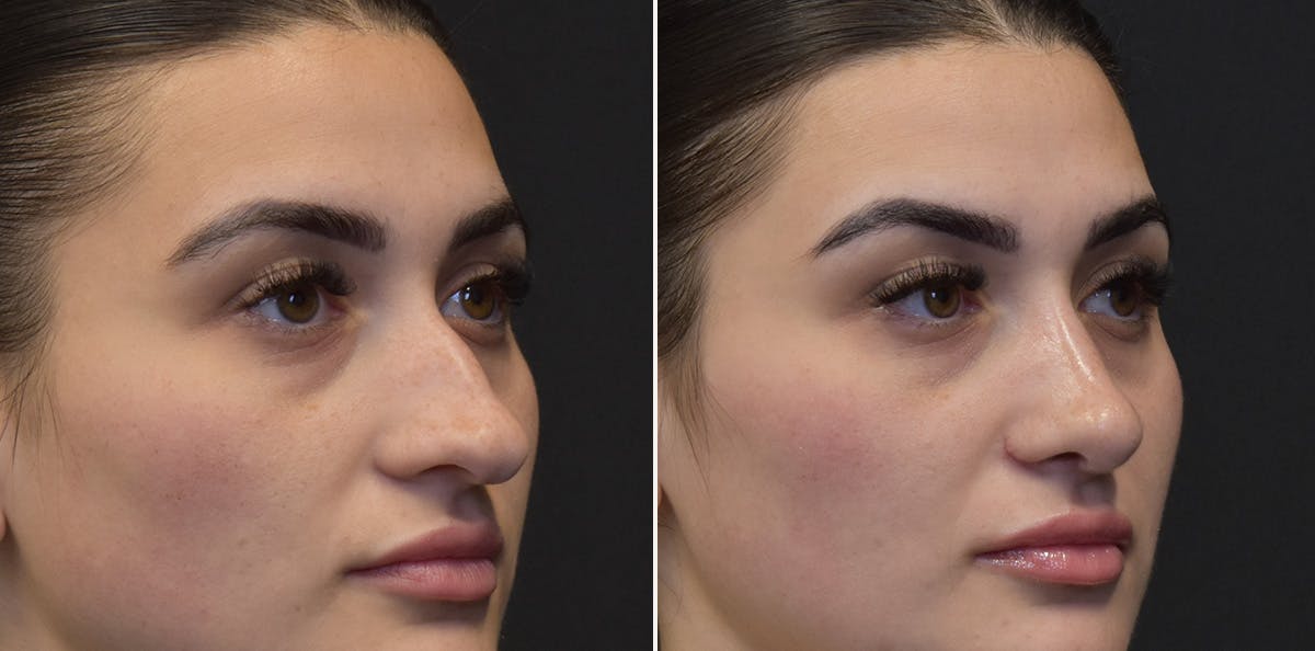 Rhinoplasty Before & After Gallery - Patient 330822 - Image 2