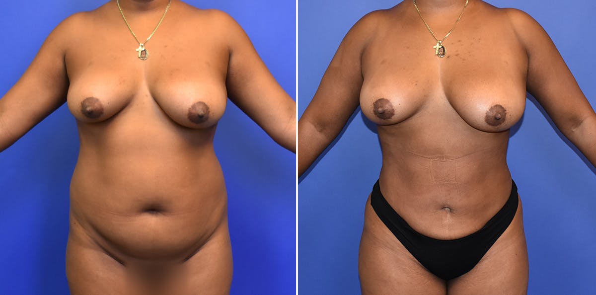 Liposuction Before & After Gallery - Patient 332721 - Image 1