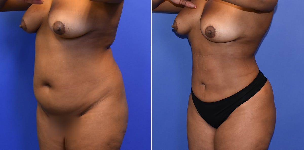 Liposuction Before & After Gallery - Patient 332721 - Image 2