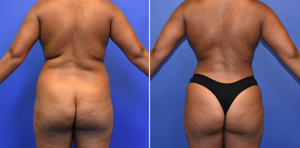 Liposuction Before & After Gallery - Patient 332721 - Image 3