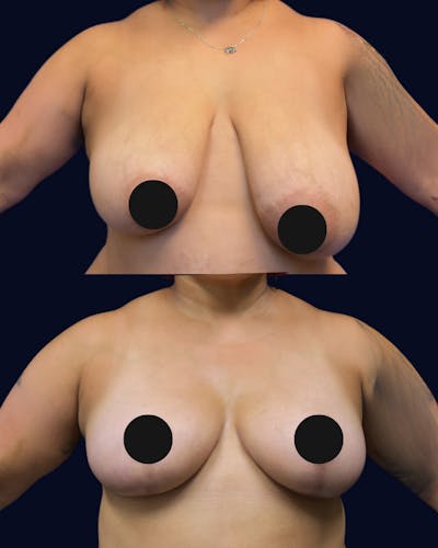 Breast Lift Before & After Gallery - Patient 126378 - Image 1
