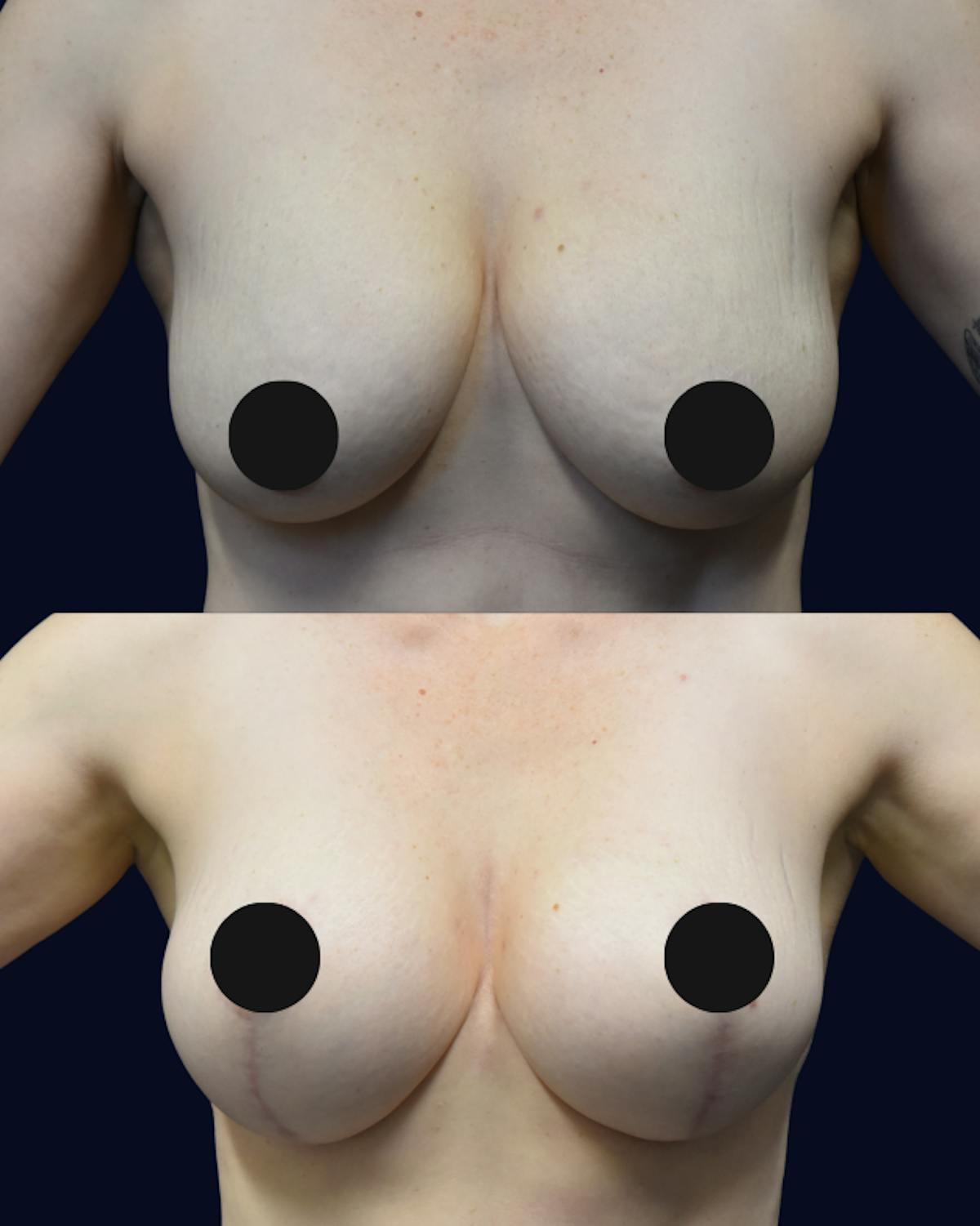 Breast Reduction Before & After Gallery - Patient 303780 - Image 1