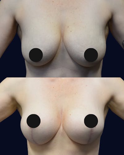 Breast Reduction Before & After Gallery - Patient 303780 - Image 1