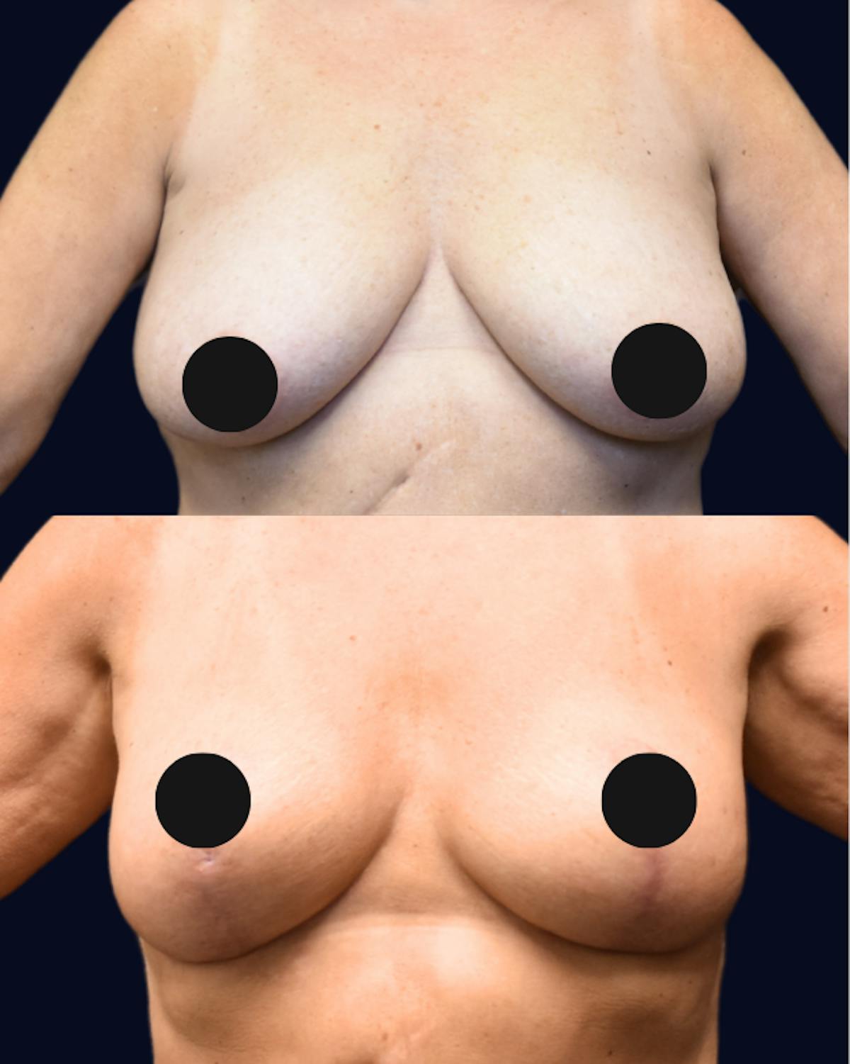 Breast Reduction Before & After Gallery - Patient 281552 - Image 1