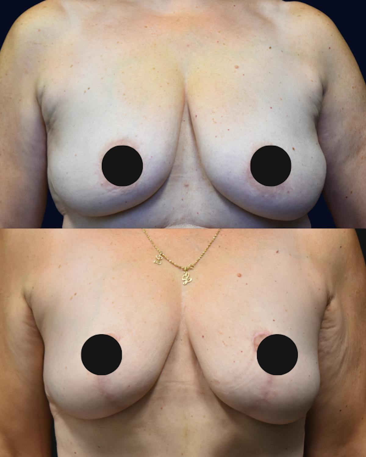 Breast Reduction Before & After Gallery - Patient 136374 - Image 1