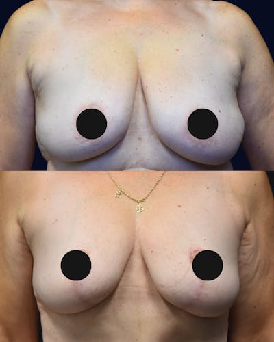 Breast Lift Before & After Gallery - Patient 138780 - Image 1