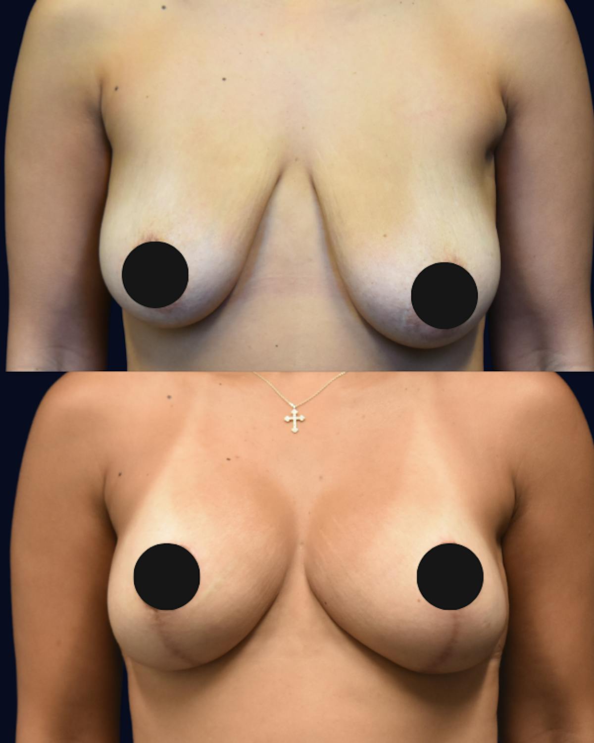 Breast Reduction Before & After Gallery - Patient 428946 - Image 1