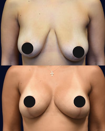 Breast Reduction Before & After Gallery - Patient 428946 - Image 1