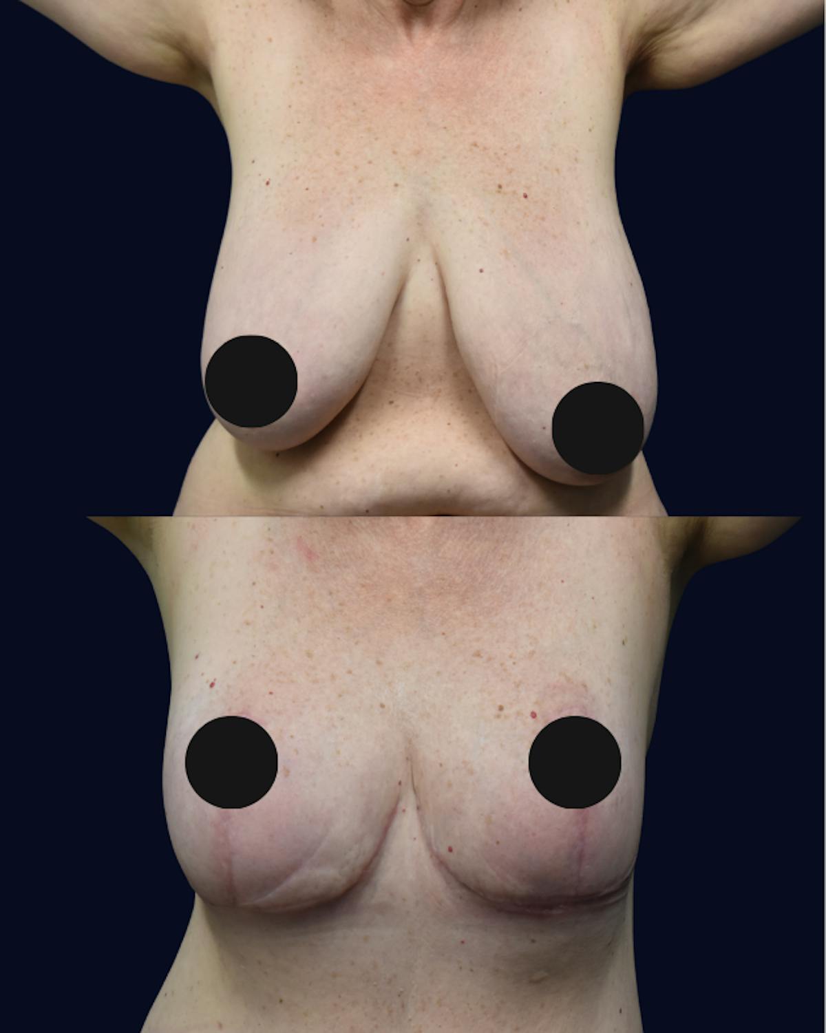 Breast Lift Before & After Gallery - Patient 139230 - Image 1
