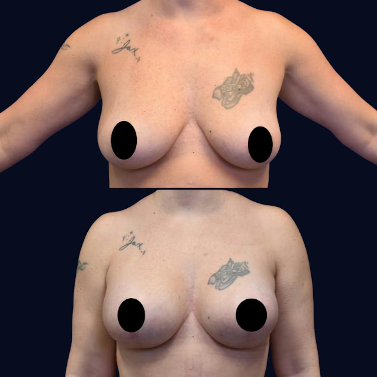 Breast Lift Before & After Gallery - Patient 342501 - Image 1