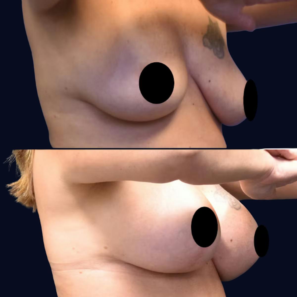Breast Lift Before & After Gallery - Patient 342501 - Image 2
