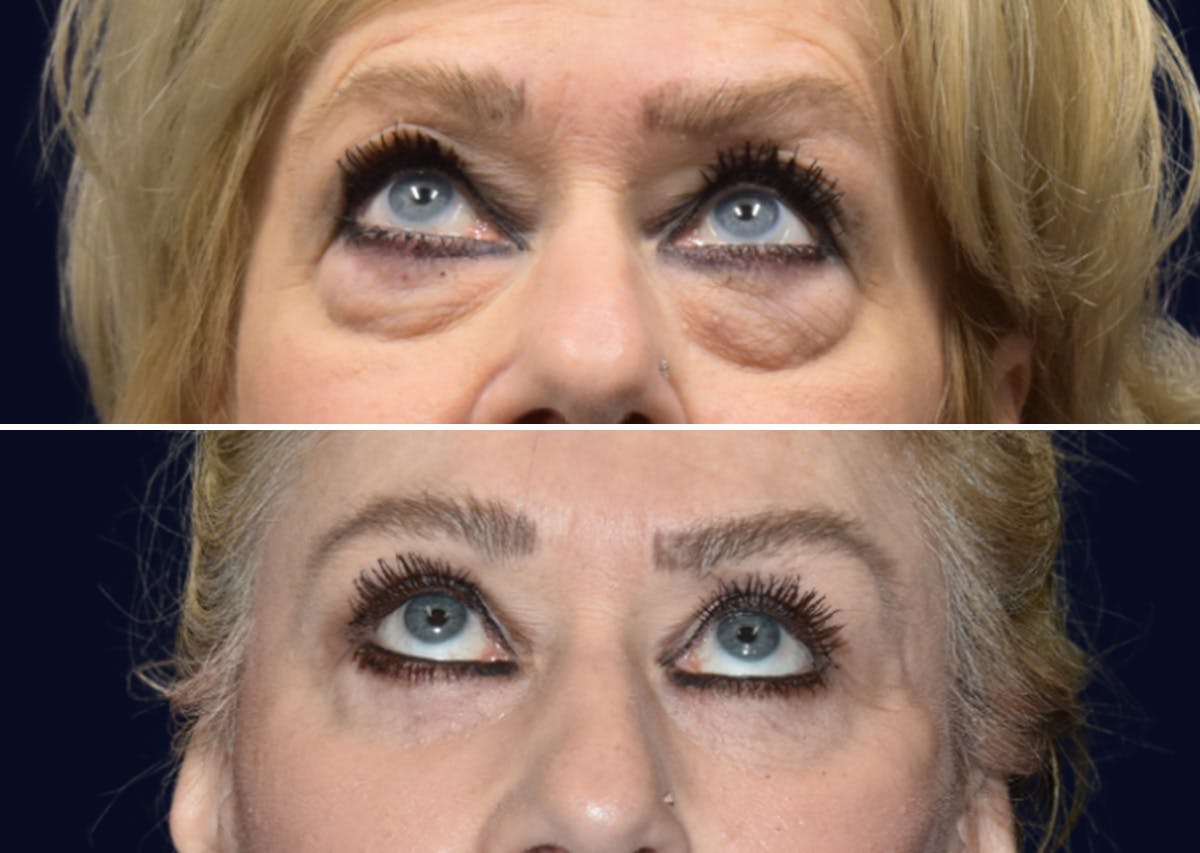 Blepharoplasty (Eyelid Surgery) Before & After Gallery - Patient 162685 - Image 2