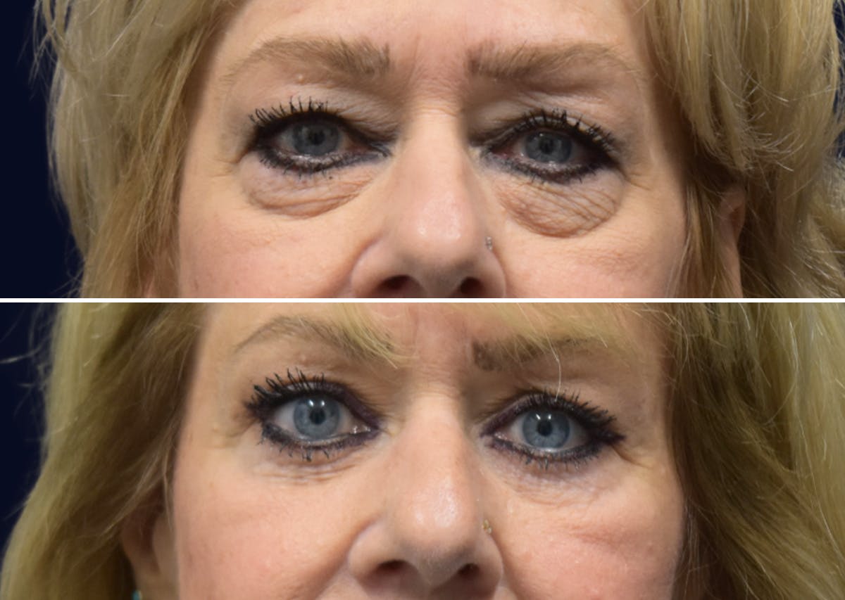 Blepharoplasty (Eyelid Surgery) Before & After Gallery - Patient 162685 - Image 1