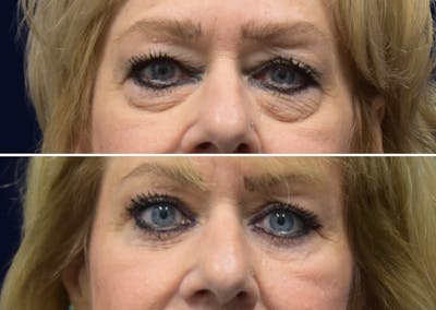 Blepharoplasty (Eyelid Surgery) Before & After Gallery - Patient 162685 - Image 1