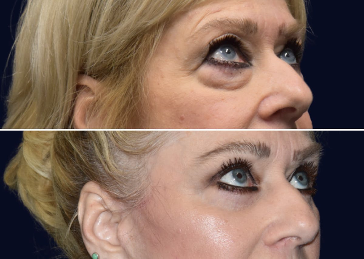 Blepharoplasty (Eyelid Surgery) Before & After Gallery - Patient 162685 - Image 3