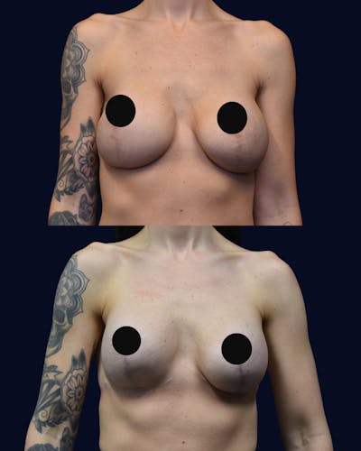 Breast Lift Before & After Gallery - Patient 422234 - Image 1