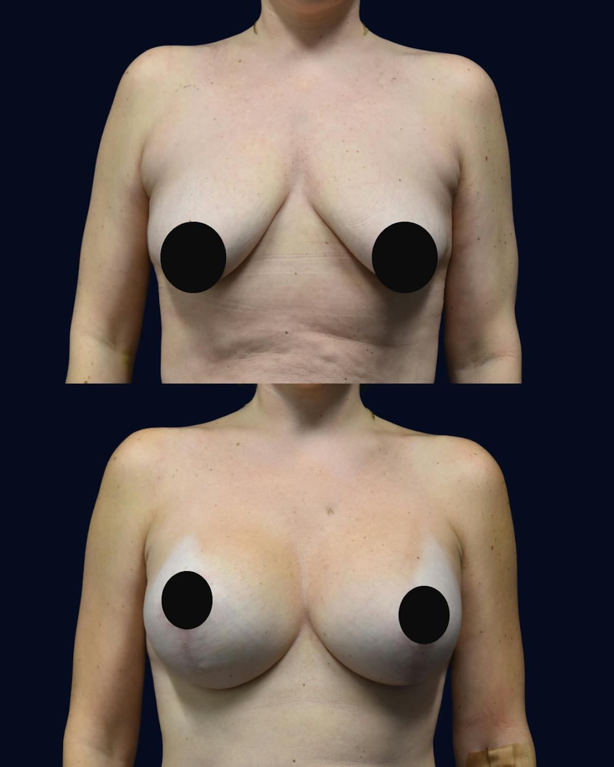 Breast Lift Before & After Gallery - Patient 428901 - Image 1