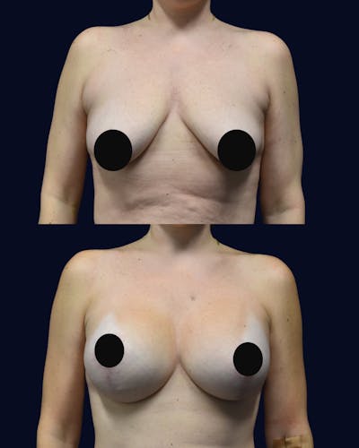 Breast Lift Before & After Gallery - Patient 428901 - Image 1