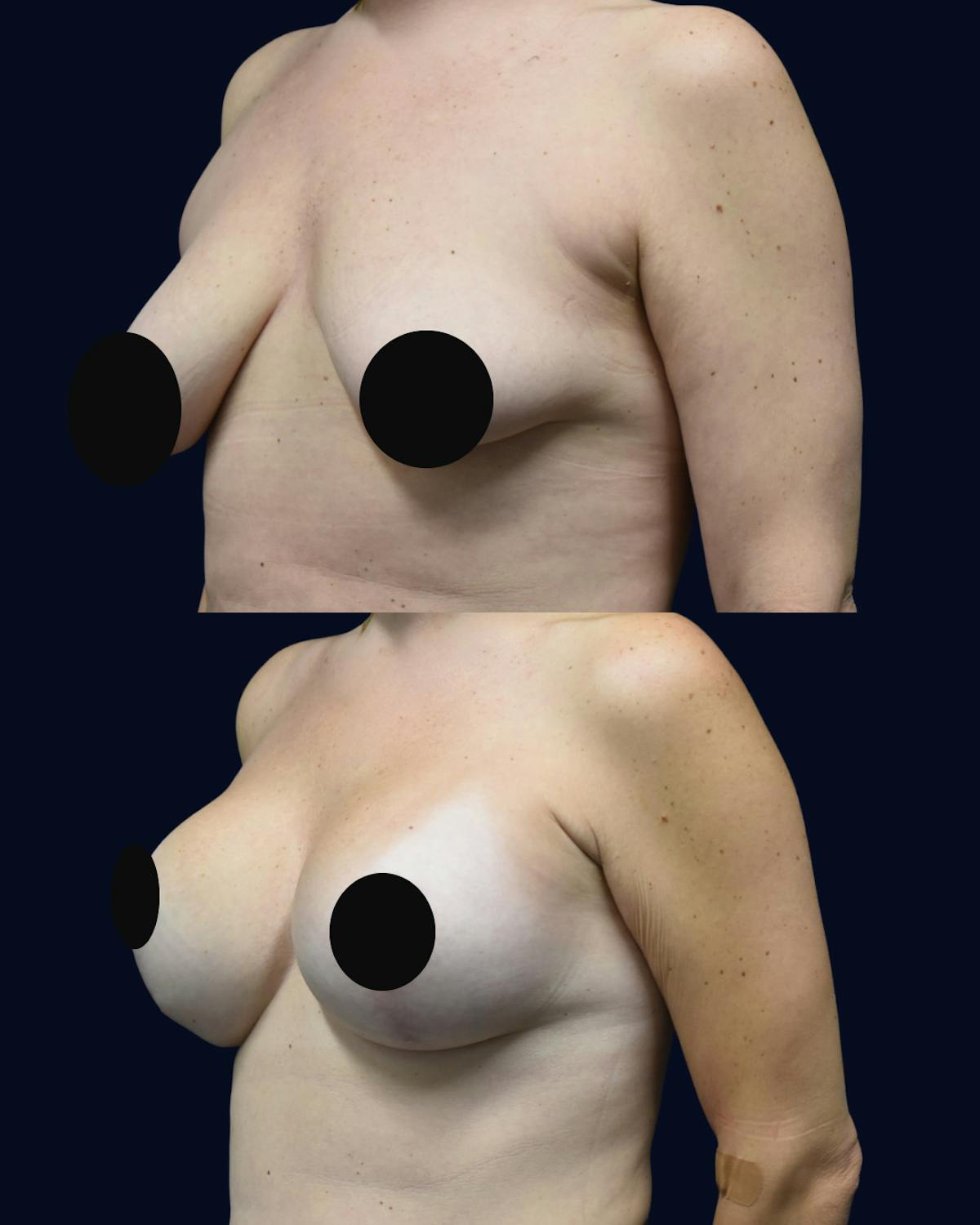 Breast Lift Before & After Gallery - Patient 428901 - Image 2