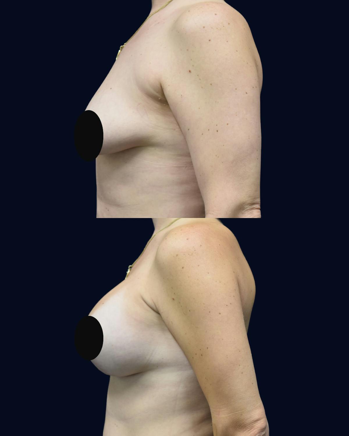 Breast Lift Before & After Gallery - Patient 428901 - Image 3