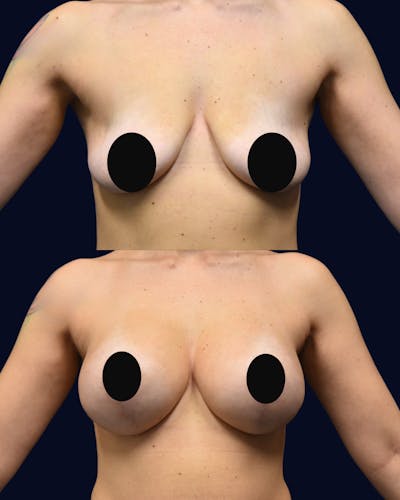 Breast Lift Before & After Gallery - Patient 101115 - Image 1