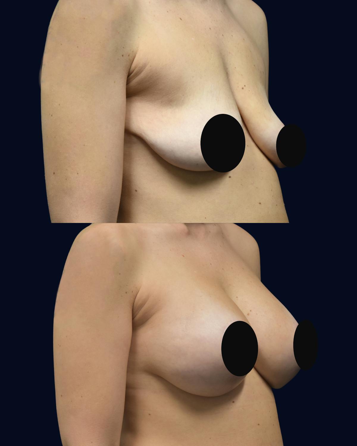 Breast Lift Before & After Gallery - Patient 101115 - Image 2