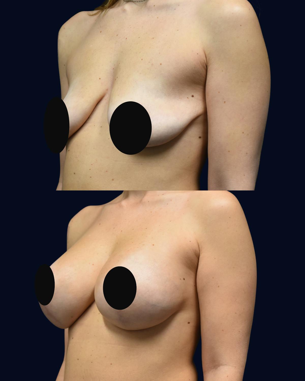 Breast Lift Before & After Gallery - Patient 101115 - Image 3