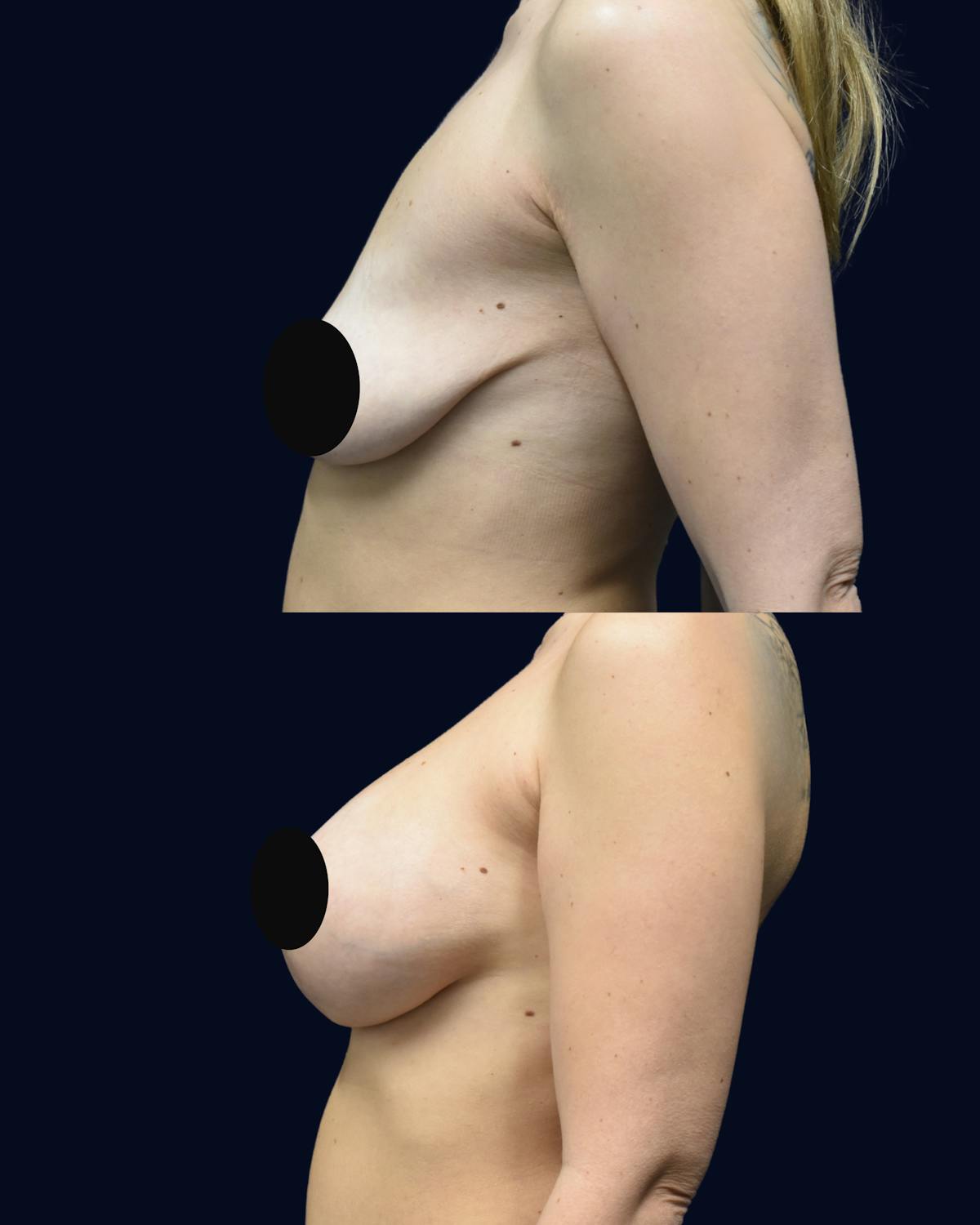 Breast Lift Before & After Gallery - Patient 101115 - Image 4
