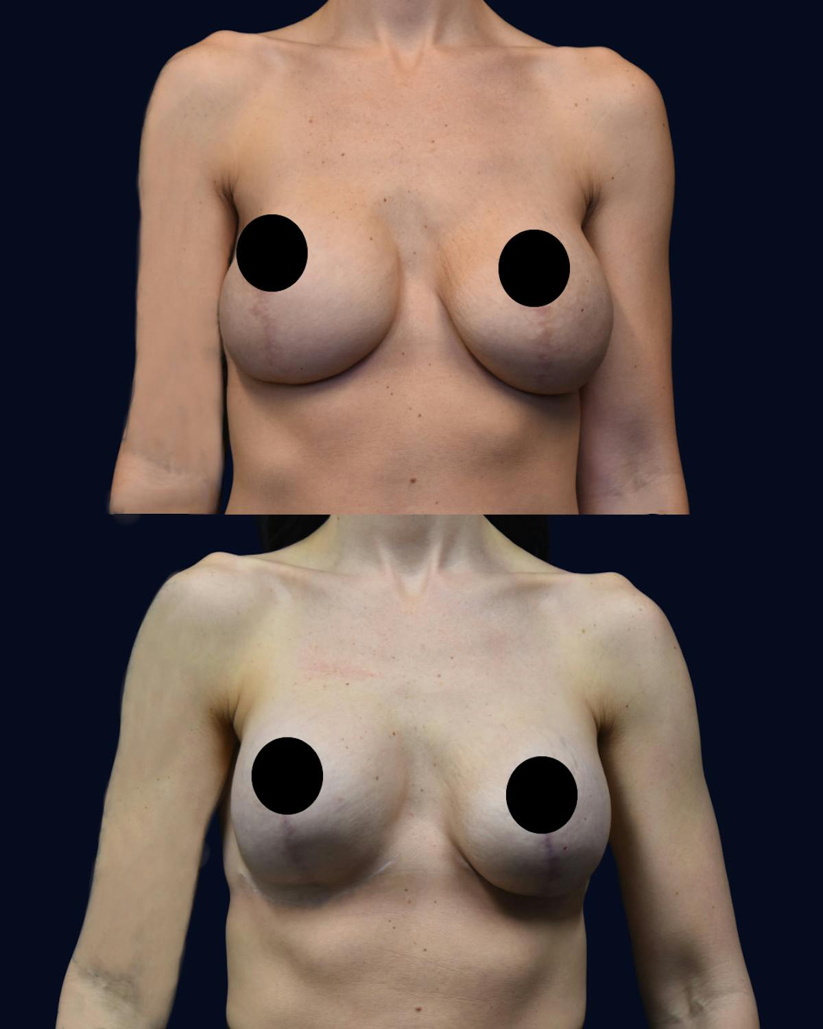 Breast Lift with Implants Before & After Gallery - Patient 151061 - Image 1